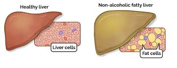 Non-Alcoholic Fatty Liver Disease (NAFLD) Treatment Ahilyanagar
